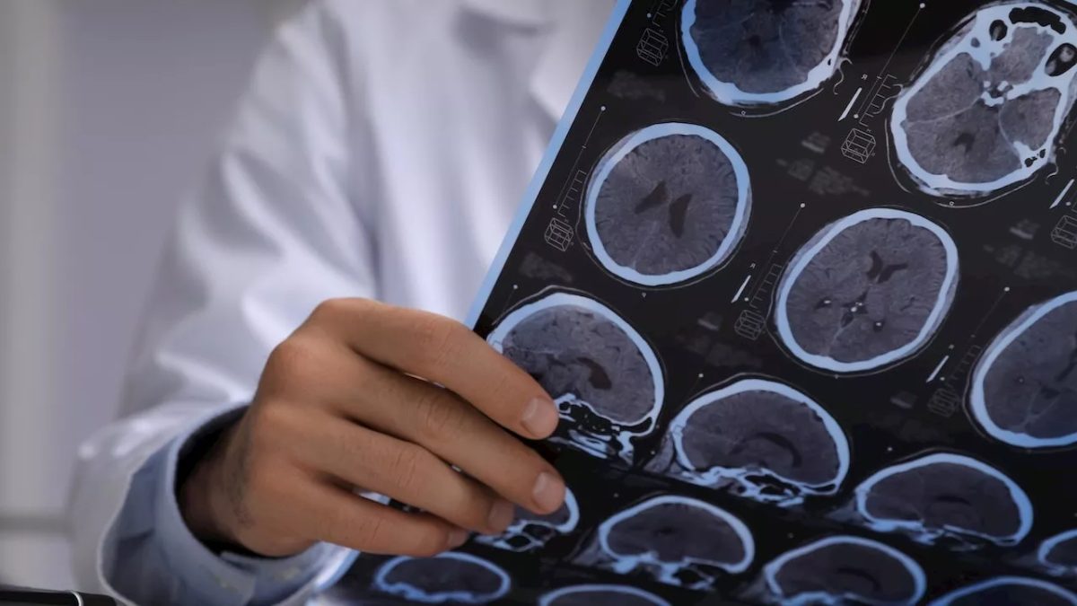 Férfinál agydaganatot diagnosztizáltak, de valójában élő galandférgek voltak benne