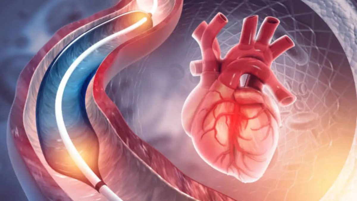 Orvos megcáfol szívmítoszt: Az angiográfia diagnosztikai, nem terápiás eljárás