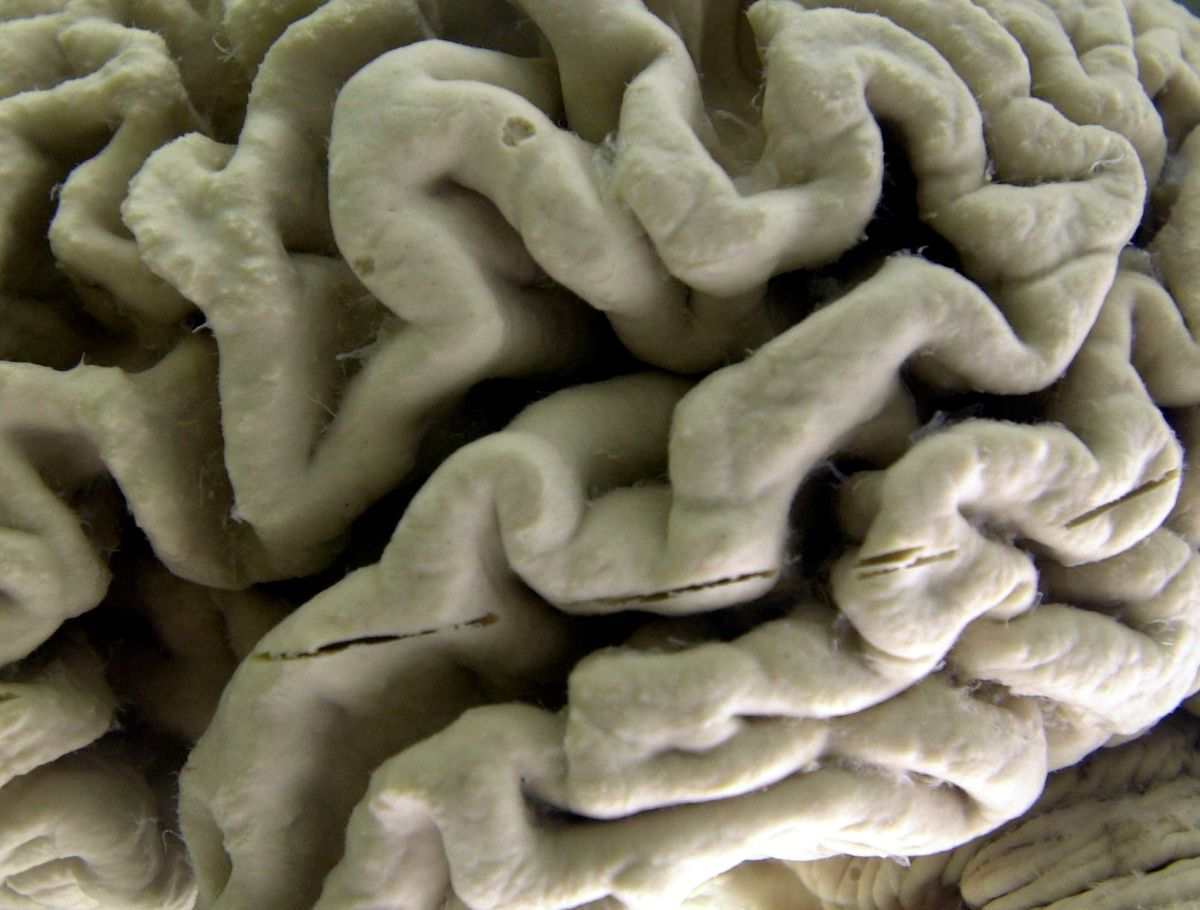 Vérvizsgálat azonosítja az Alzheimer-kockázatot egészséges egyéneknél