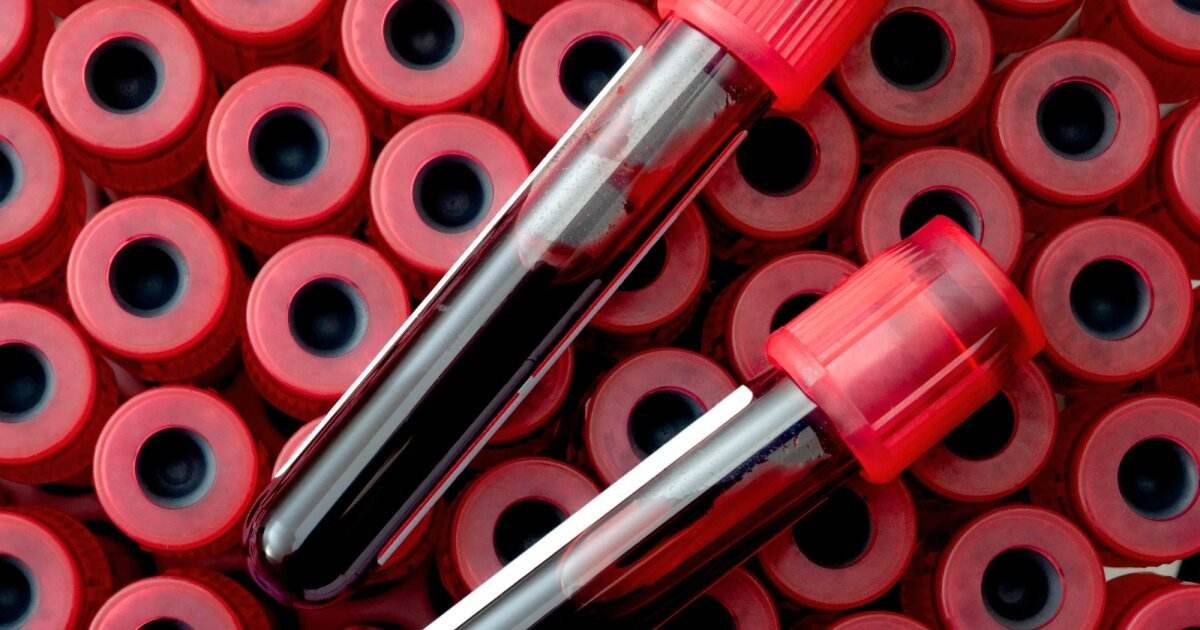 Vérvizsgálat évtizedekkel a tünetek megjelenése előtt előrejelezheti a demenciát