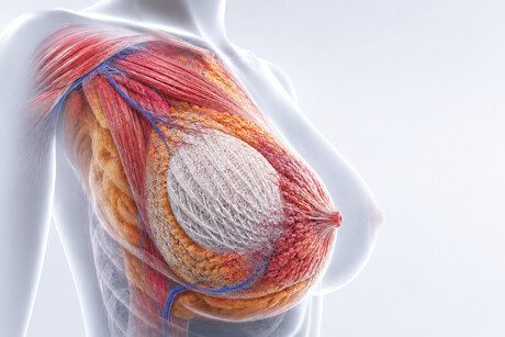 Felszívódó állványzatok regenerálják az elveszett mellszövetet