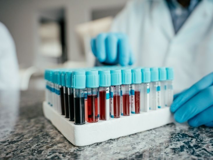 Vérvizsgálat akár 10 évvel a tünetek megjelenése előtt kimutathatja az Alzheimer-kór kockázatát