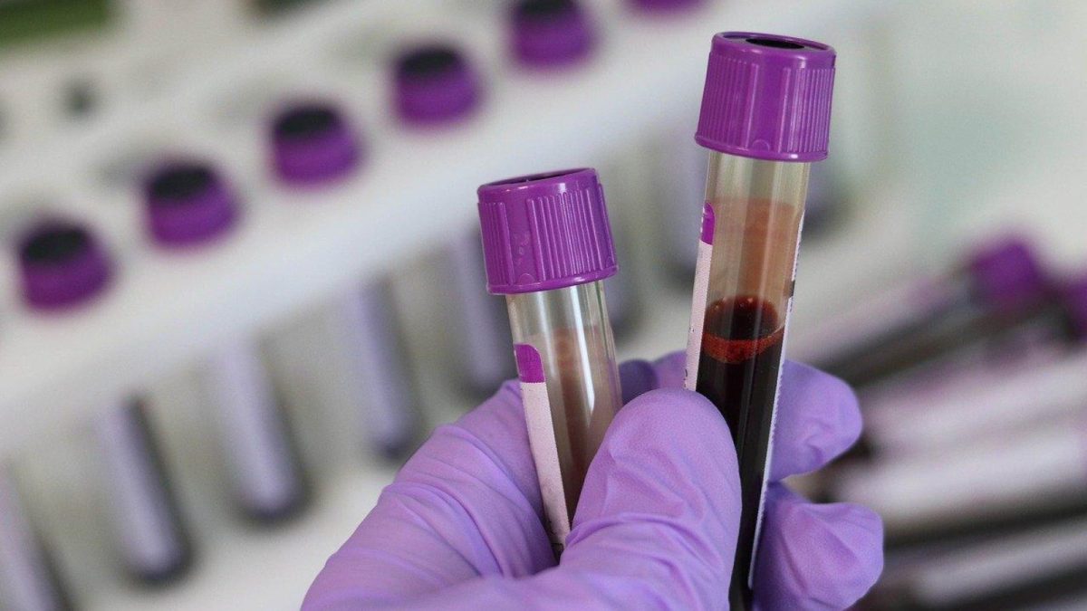 Krvný test Univerzity Kanazawa odhalí 90 % rakovín pankreasu v ranom štádiu